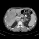 Liver tumour, 3-phase CT: CT - Computed tomography